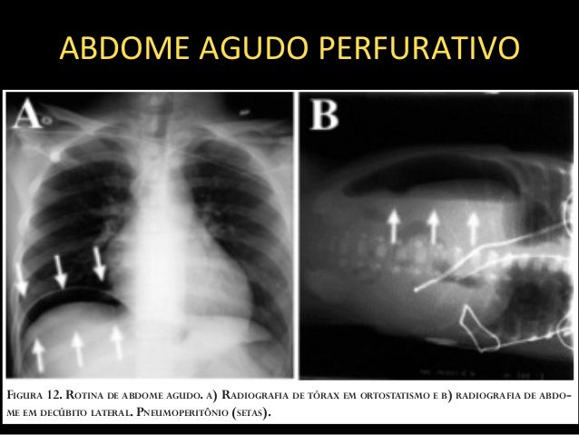 abdome agudo perfurativo